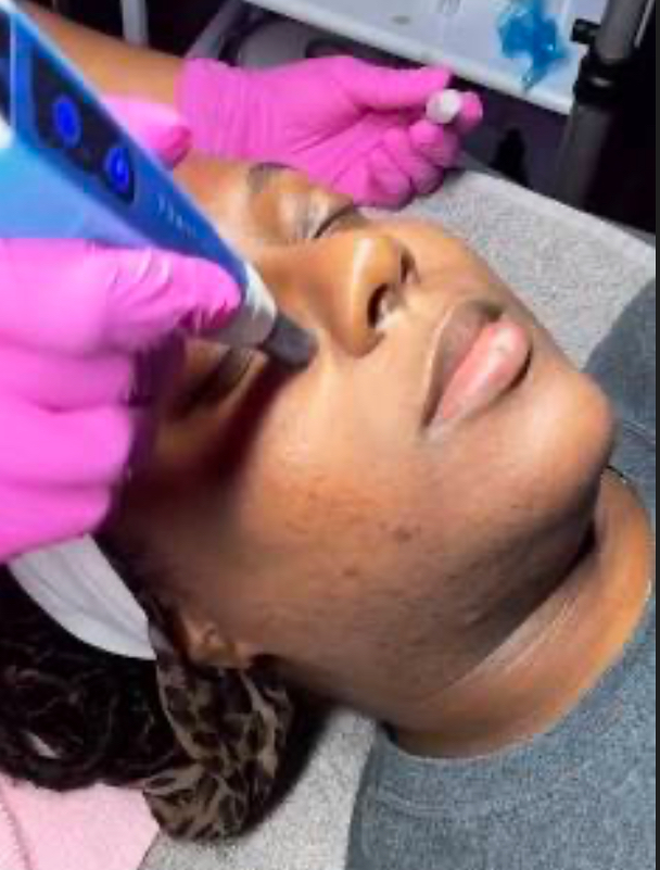 Microneedling