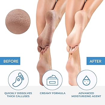 Meticulous Callus/Cuticle