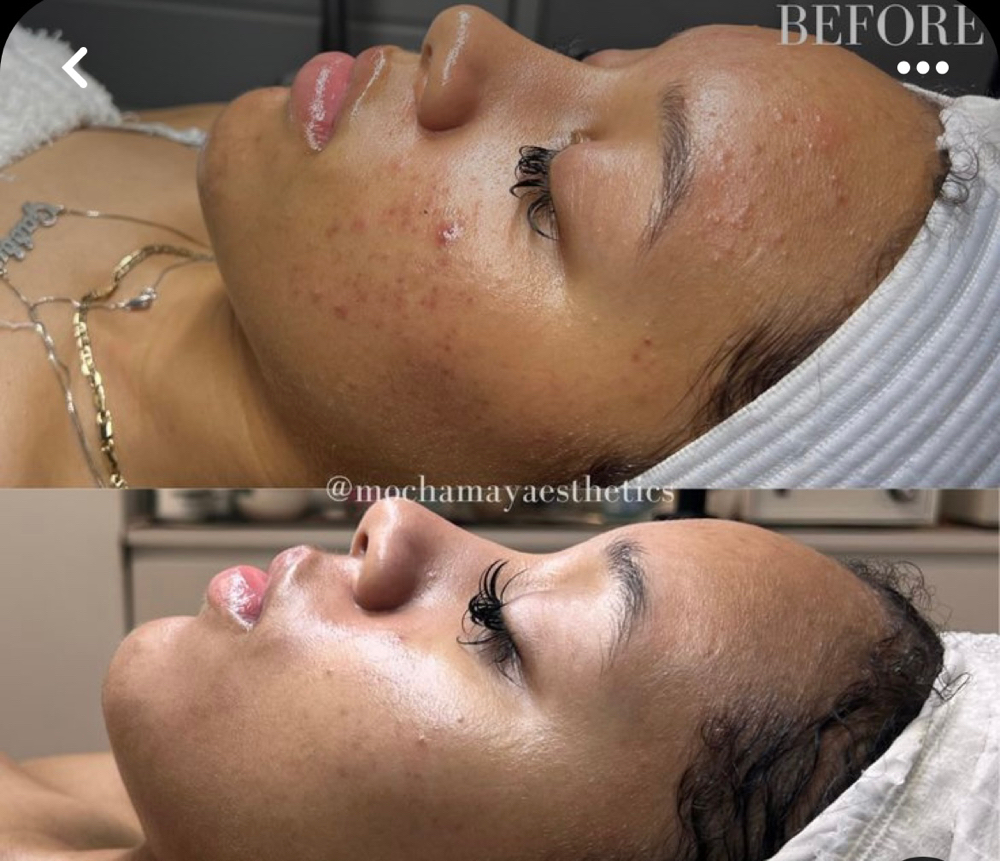 Acne Facial