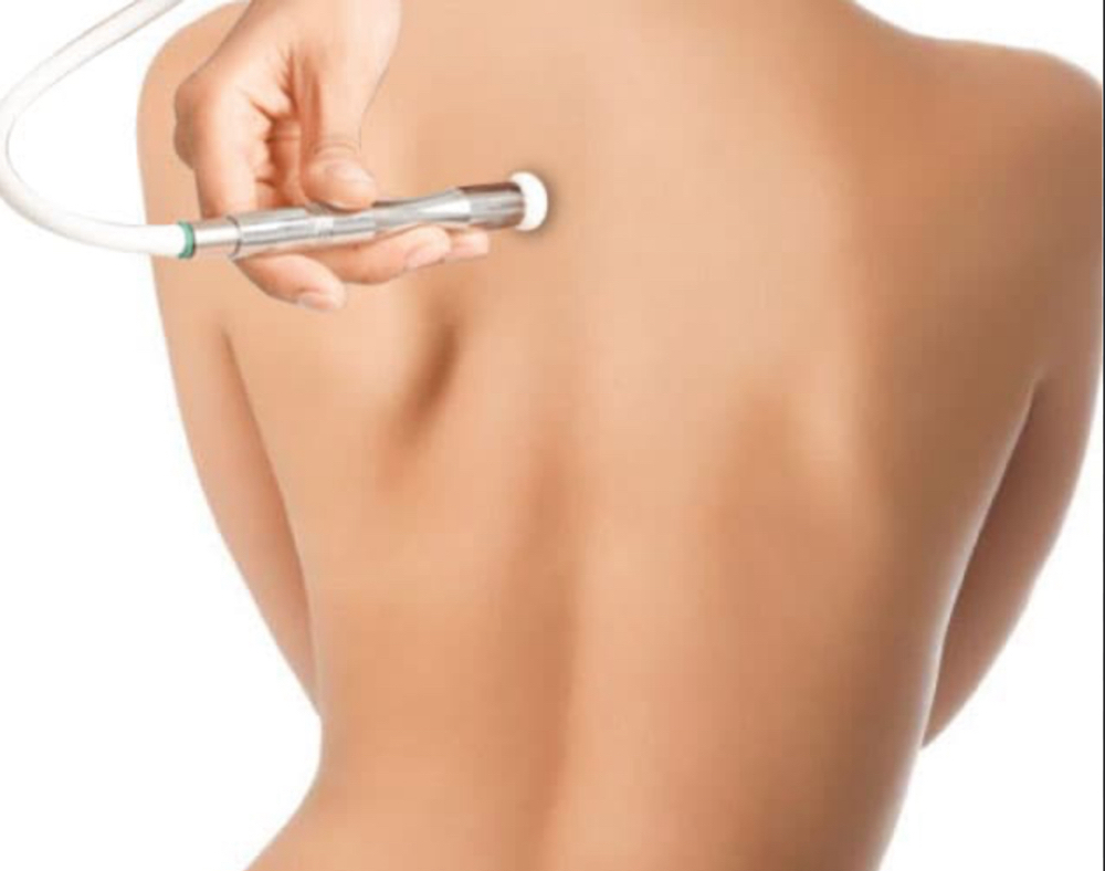 Back Facial & Diamond dermabrasion