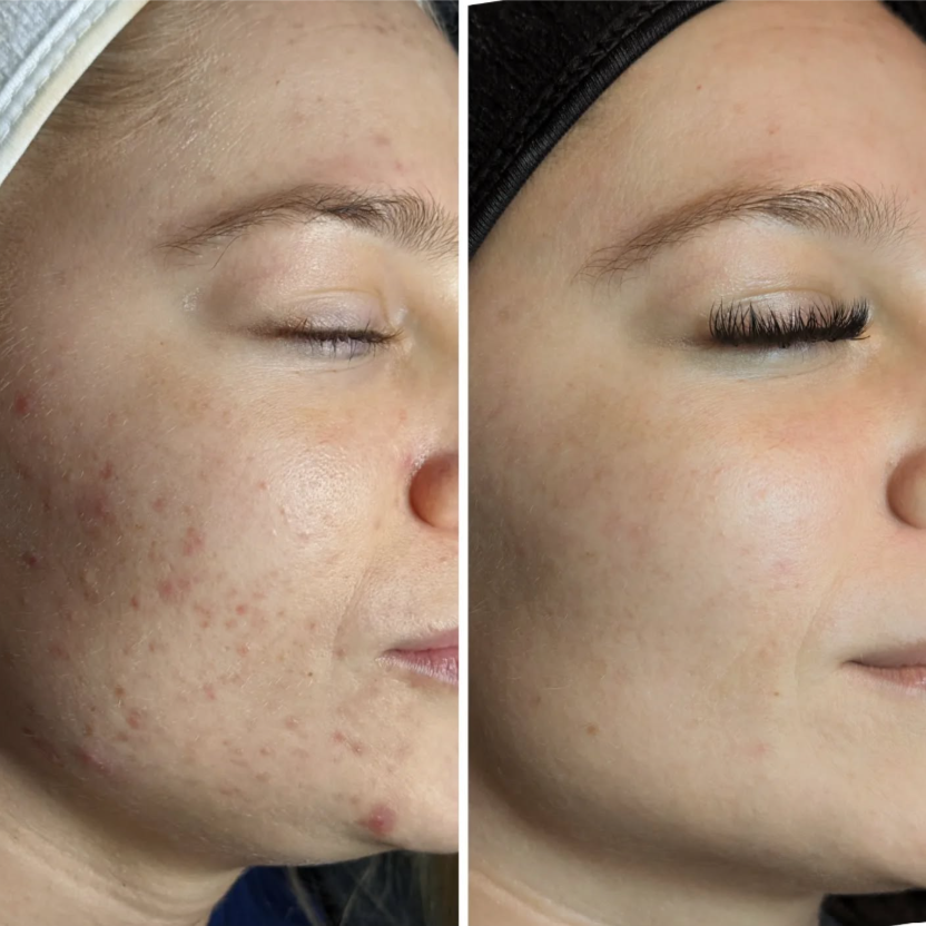 Skin Reset Intensive – 3 Visits at Yesskin Skin Care in Tarpon Springs, FL