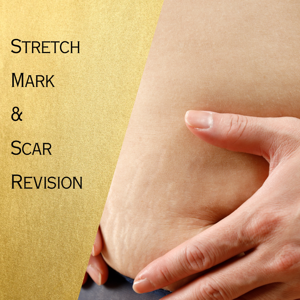 Stretch Mark / Scar Revision