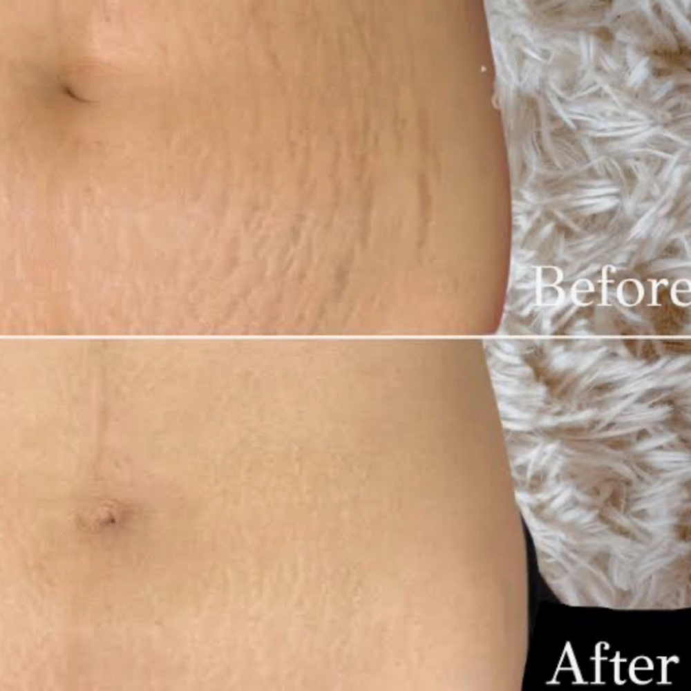 Stretch Mark / Scar Revision at Rewind Med Spa in Longmont, CO