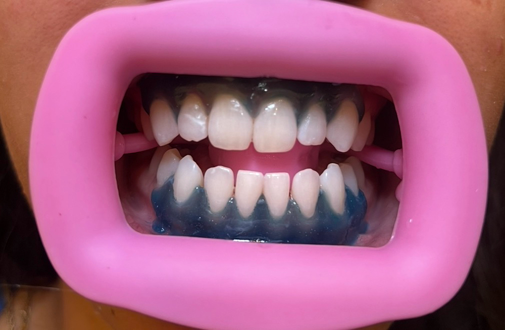 NEW CLIENT Sensitivity Whitening at Skin Promises in Las Vegas, NV