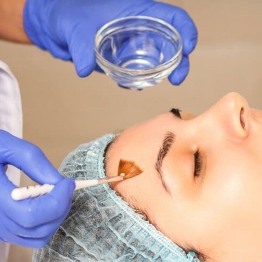 Chemical Peel | Acne | Add-on at Vice Kingz Esthetics in Murrieta, CA