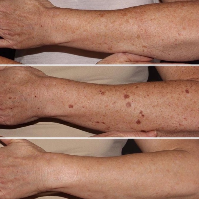 BBL Forearm (Partial) at The Skin Concierge in Northbrook, IL