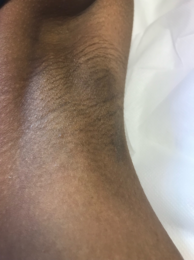 Waxing - Underarms