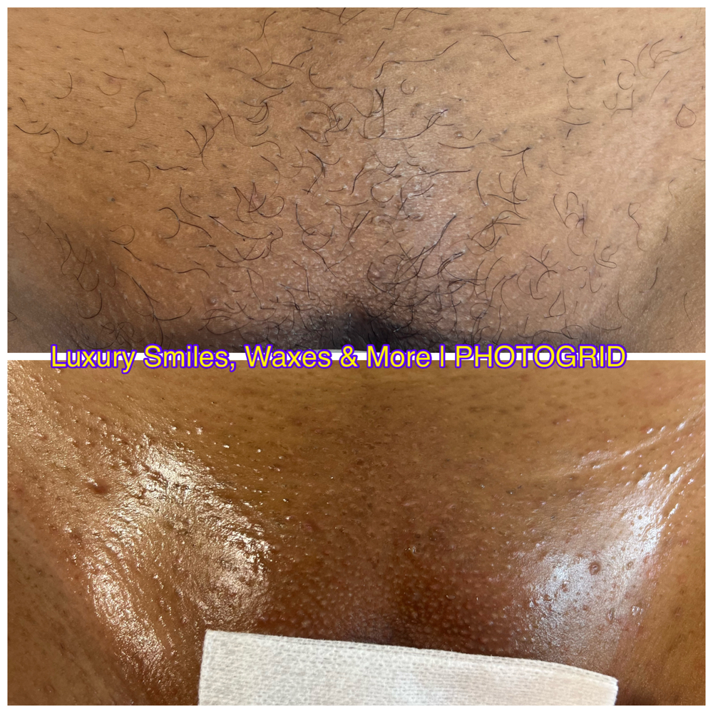 Brazilian Wax *5 Weeks Or Less* at Luxury Smiles, Waxes & More in Dallas, TX