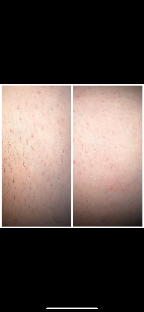 Permanent Laser Hair Removal