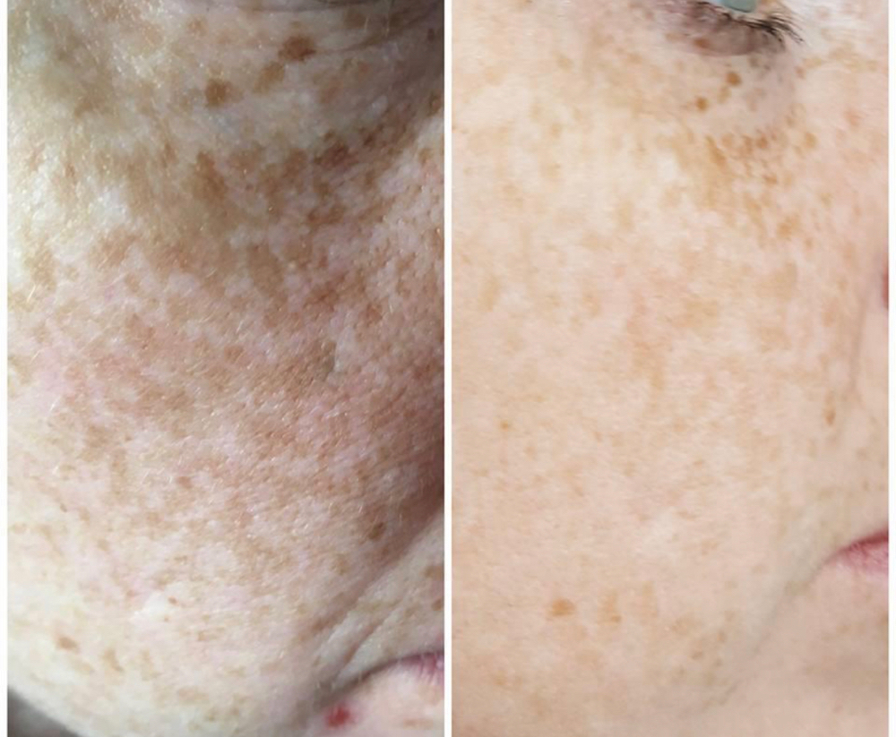 Customized Results Facial