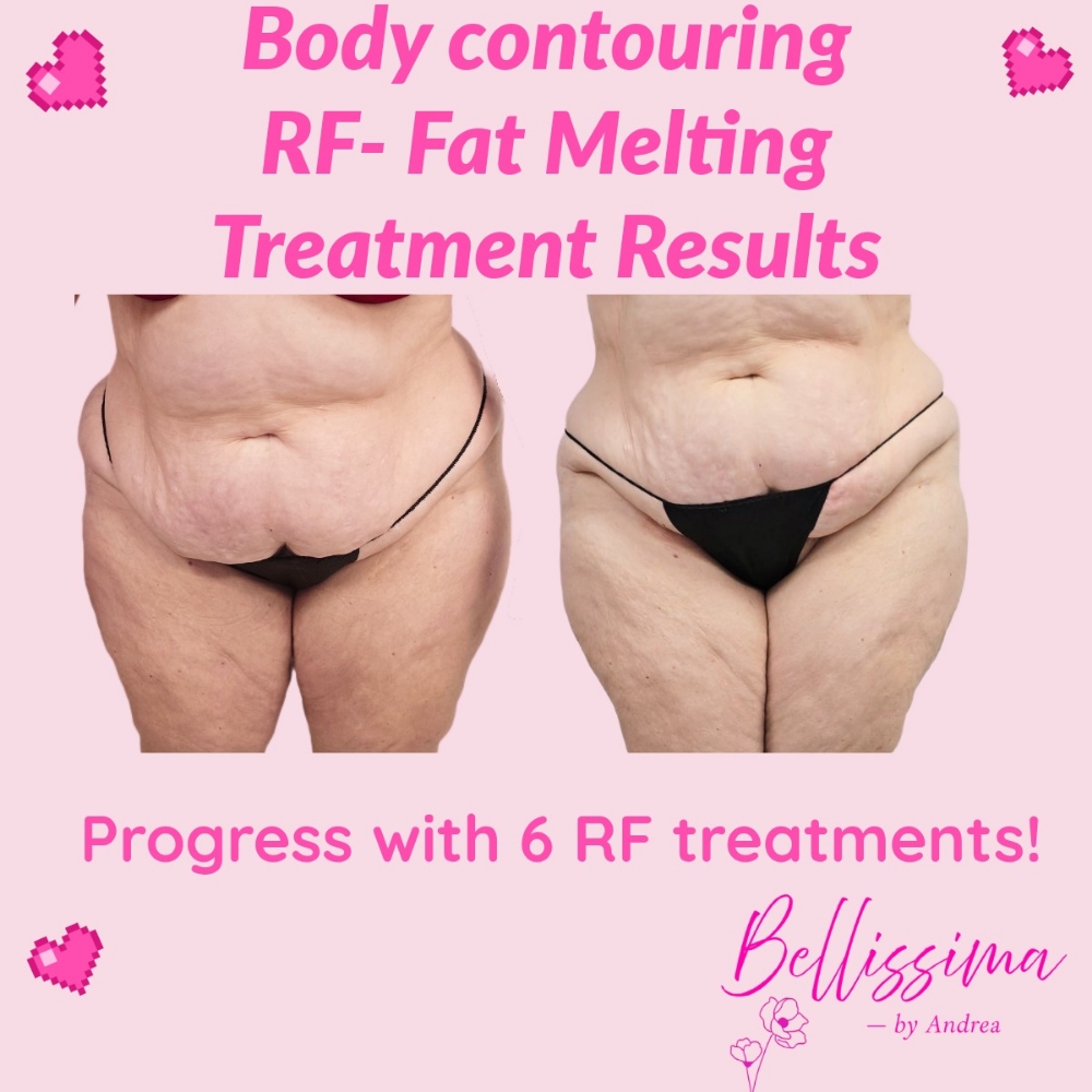 RF Body Contouring Package Of 3 at Bellissima by Andrea in El Paso, TX