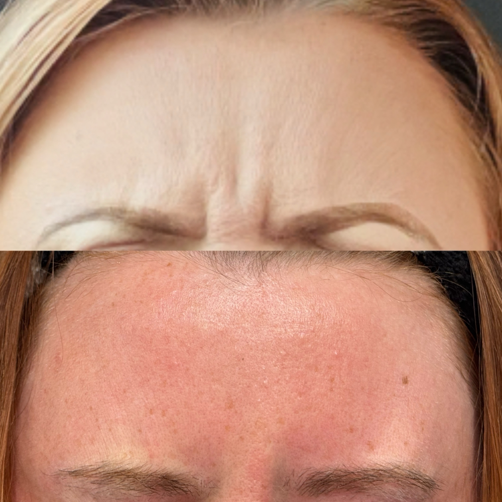 Frown Line Tox at Aesthetic Beauty Bar, LLC By Haley in Tyler, TX