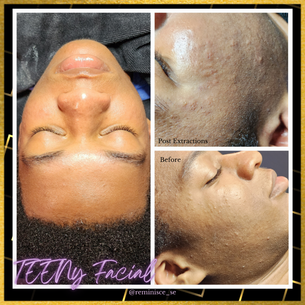 TEENy Facial