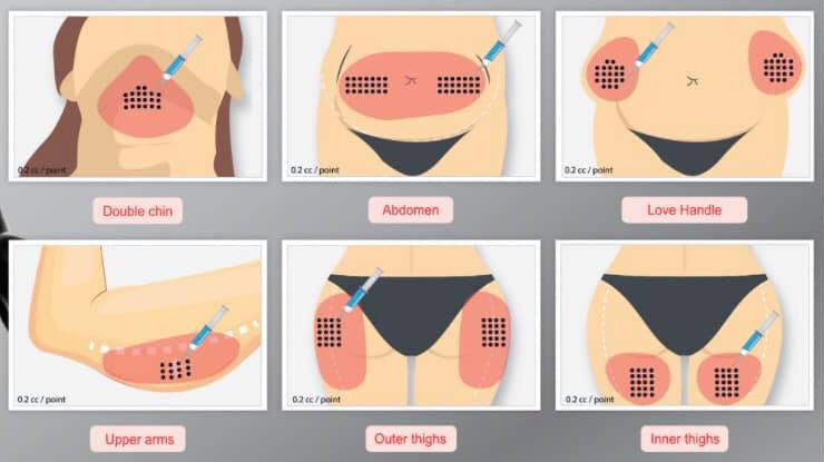 Meso Lipo