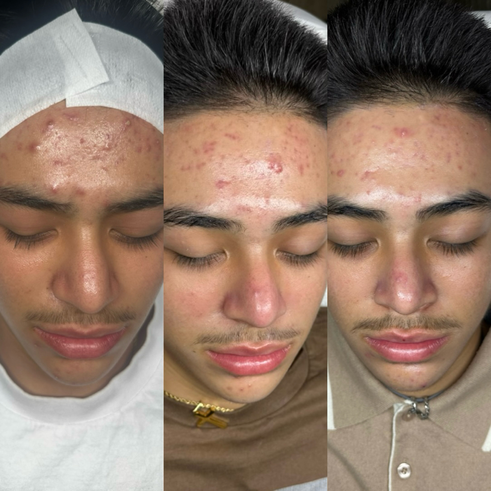 Acne Facial