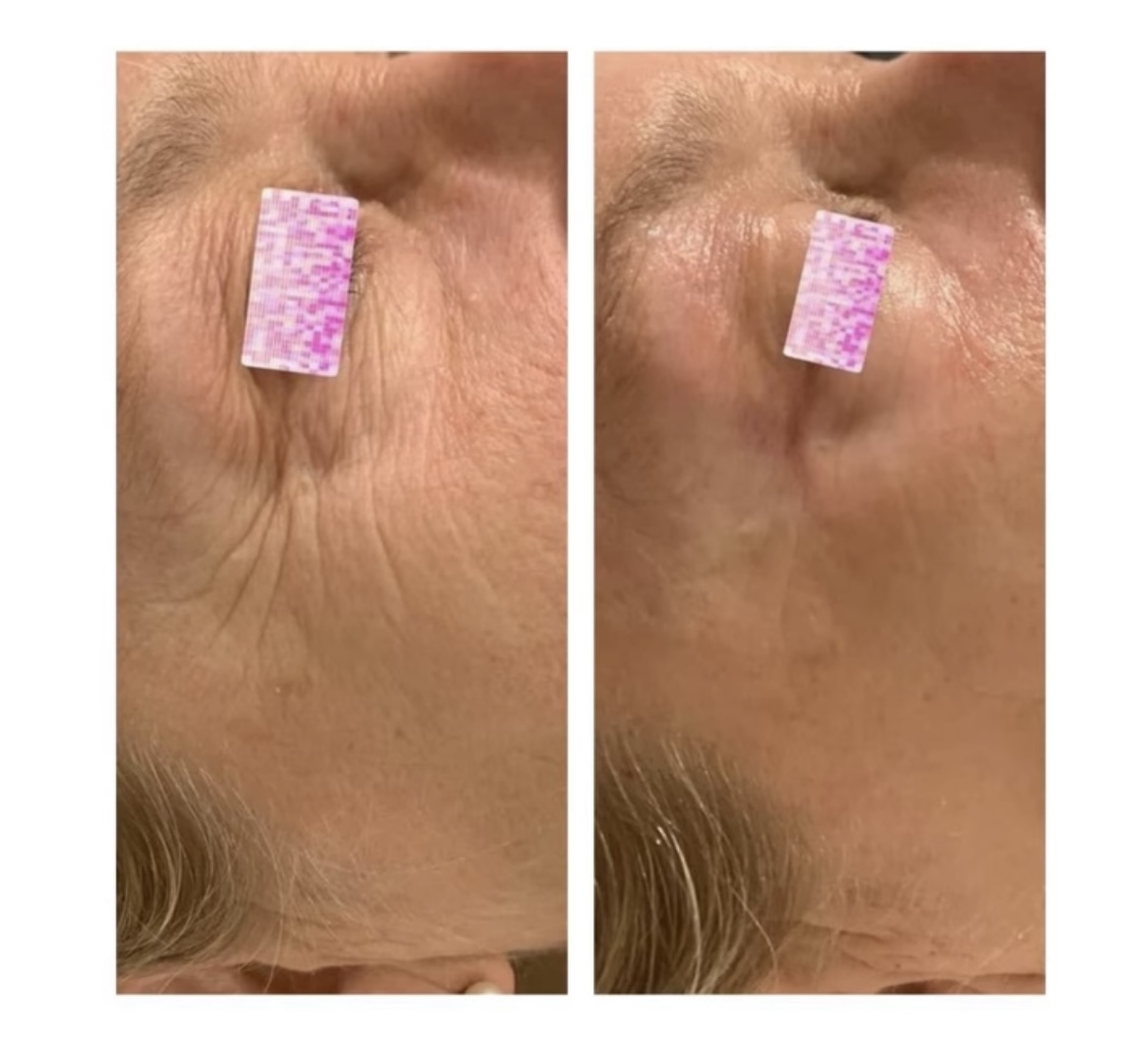 LASER SKIN REJUVENATION