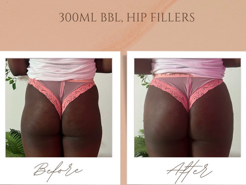 Non-Surgical Brazilian Butt Lift (B
