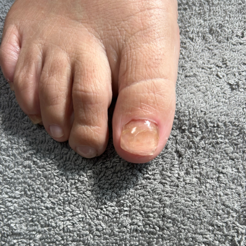 Fill-In Toenail Restoration at Sole 2 Soul Spa in Wilmington, NC