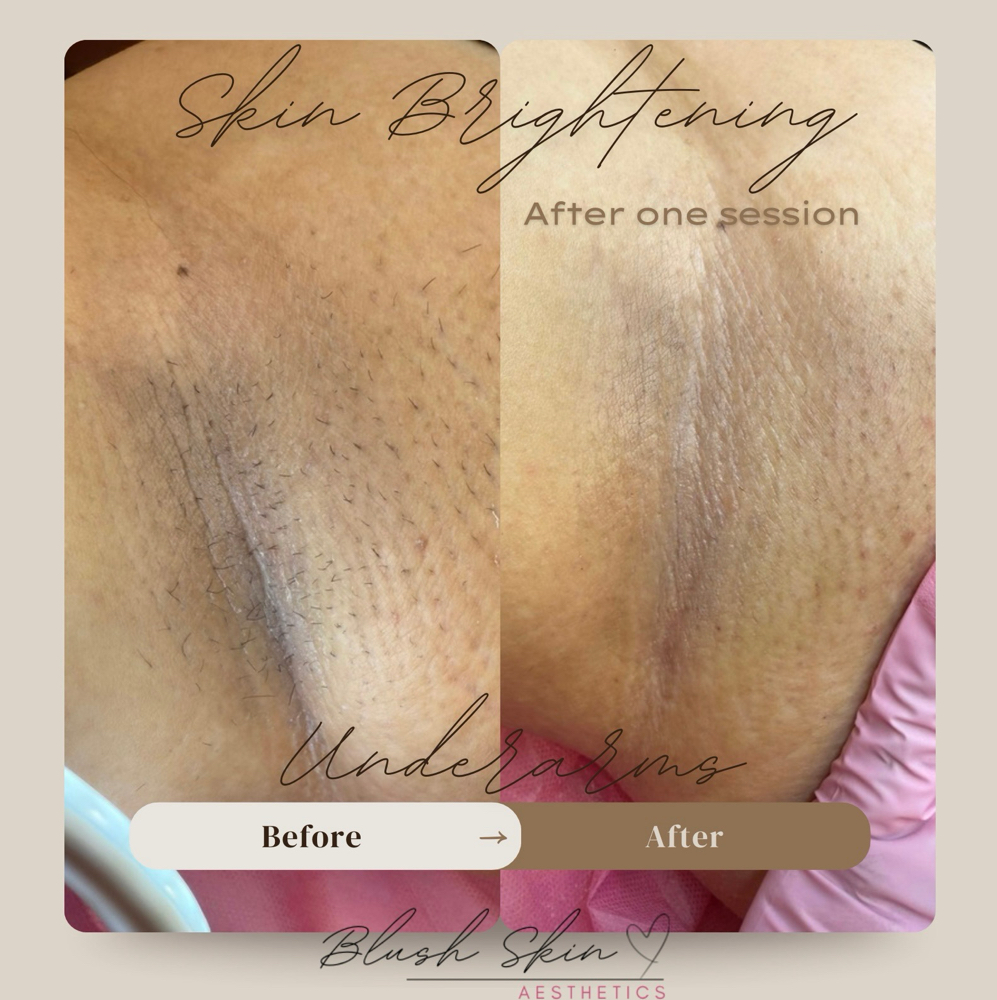 Underarm Brightening