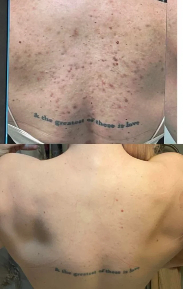 Back Acne Consultation/Treatment