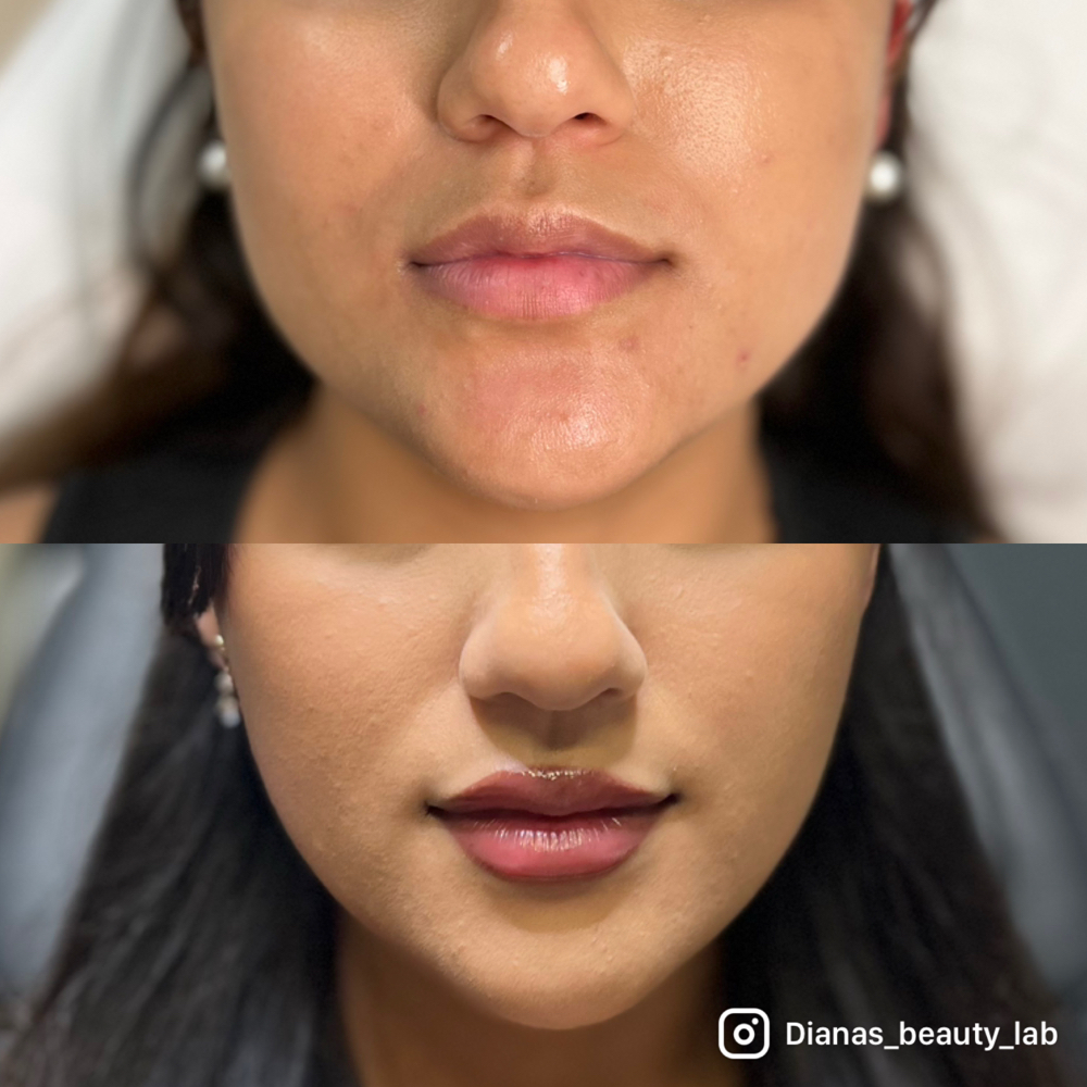 Masseter Botox