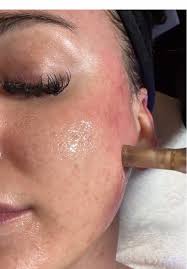Microneedling + Peel