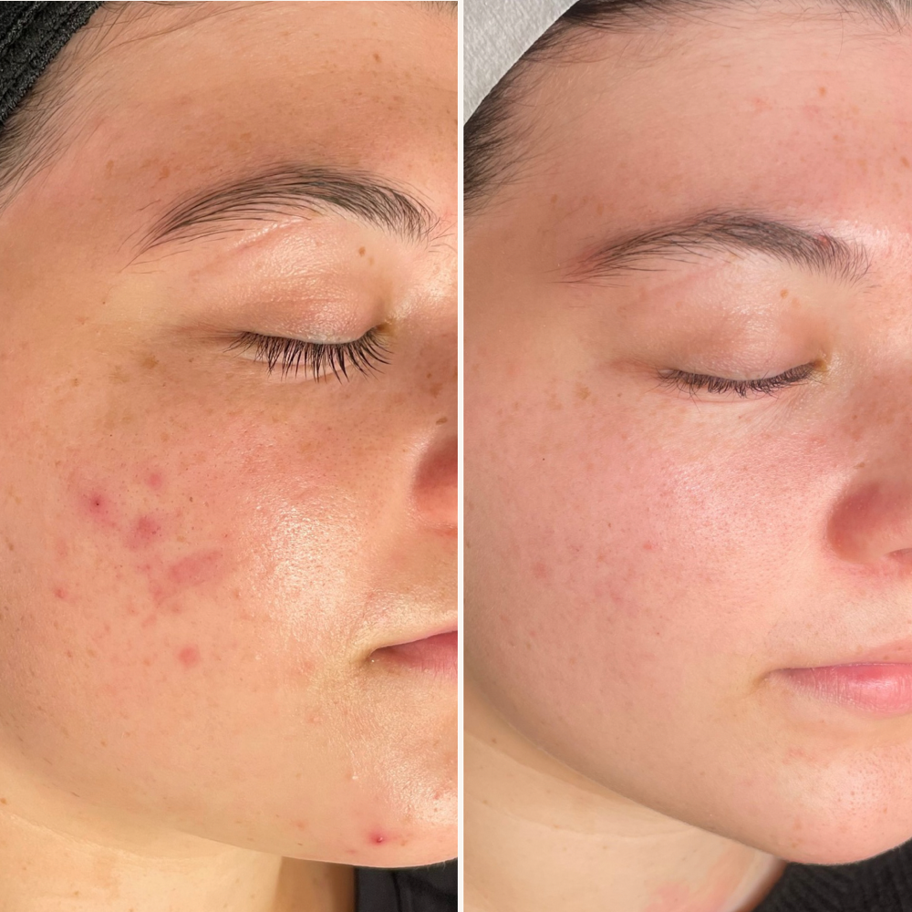 Face Reality Acne Program