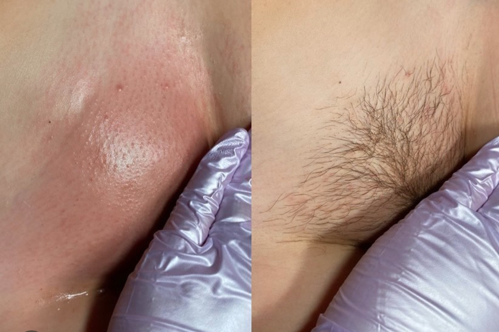 Brazilian Wax