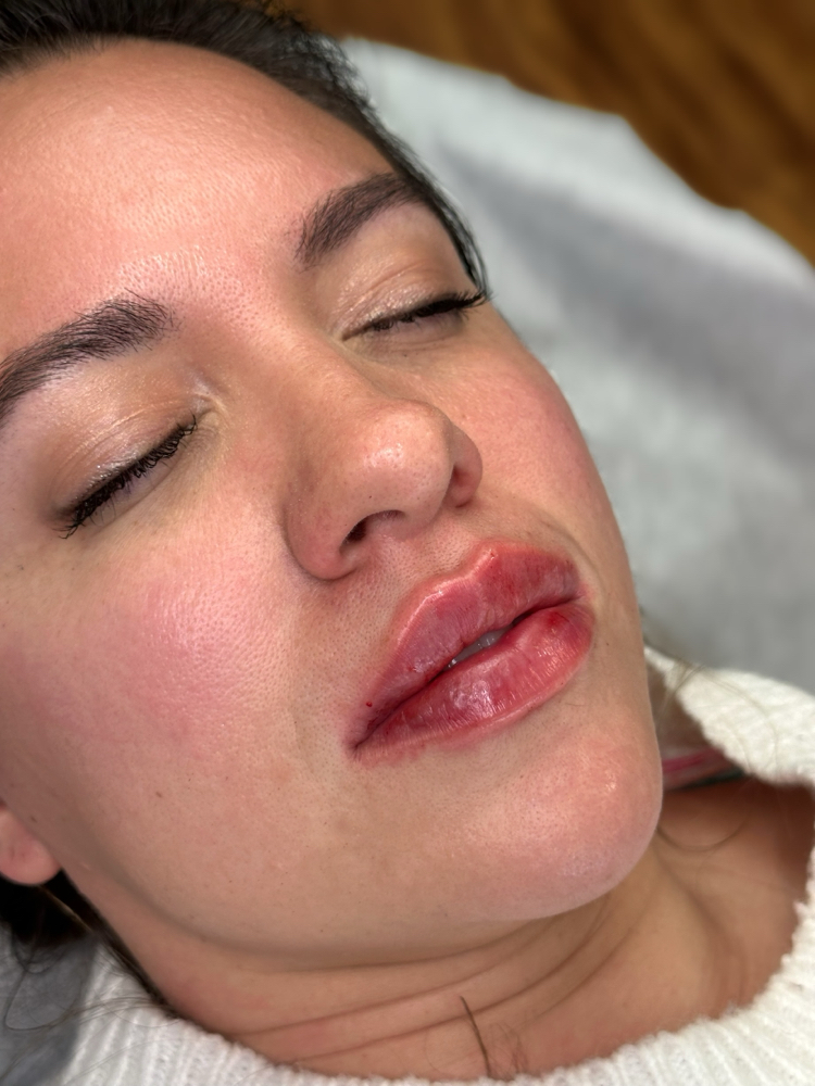 Lip Filler