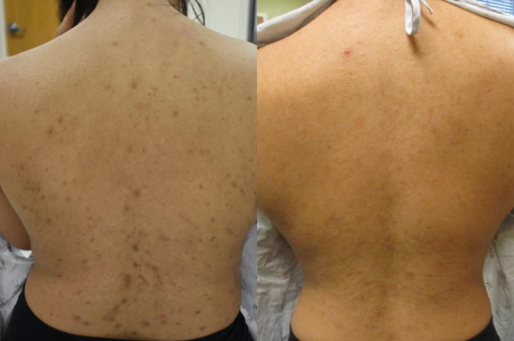 Back Chemical Peel (3 Appointments)