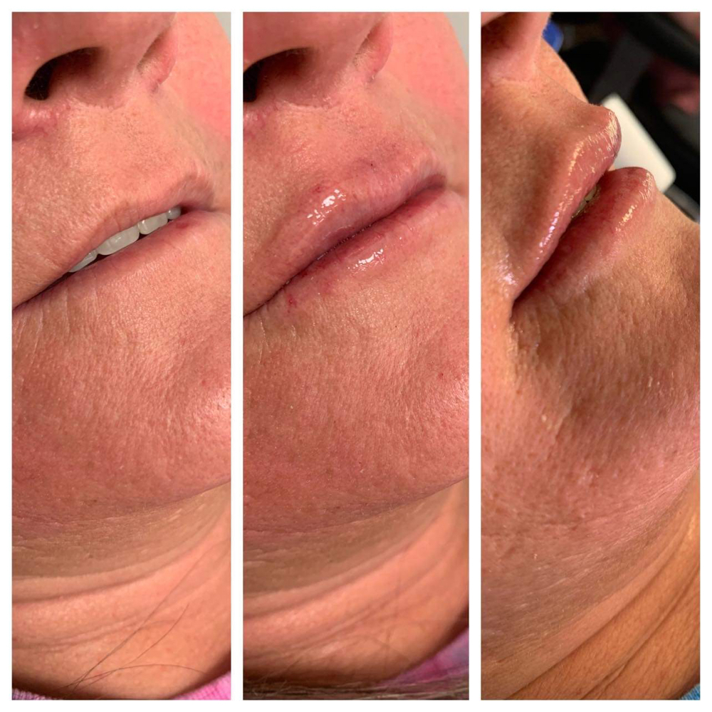 Needles Lip Injections