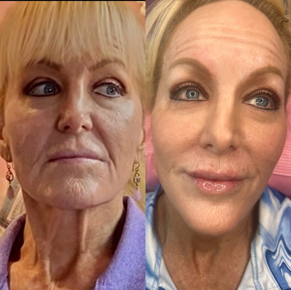 Lower Face Rejuvenation