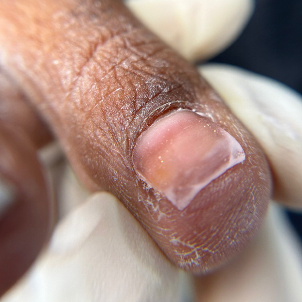 Returning Reconstruction Clients at Desirable Clawz in Hampton, GA