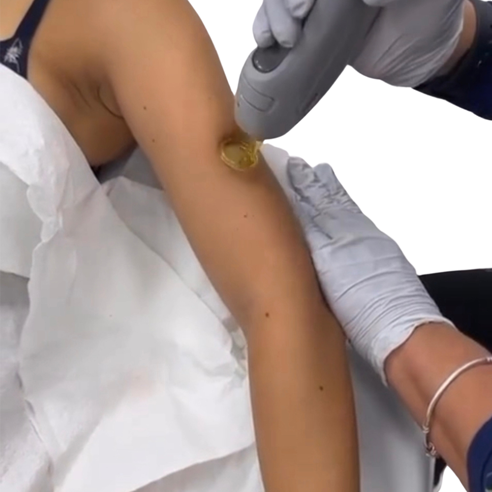 Full Arm Laser Hair Removal (single