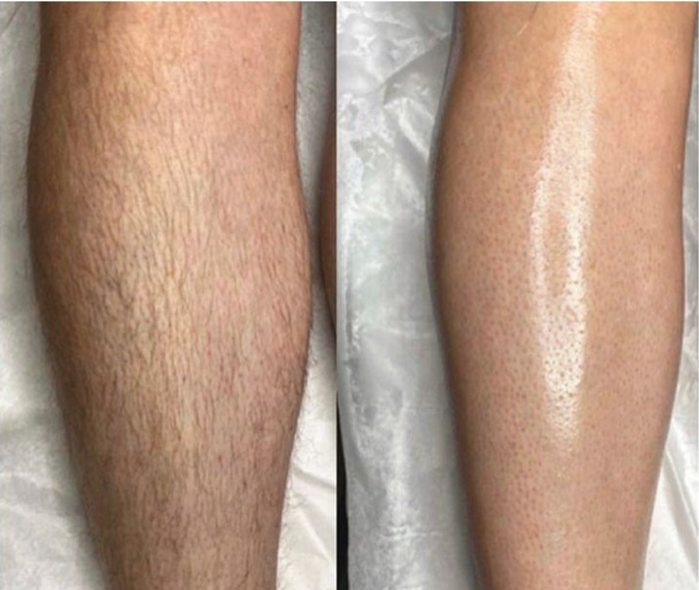 FULL LEG