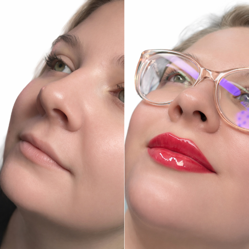 Lip Filler at BlackBird Aesthetics in Fort Worth, TX