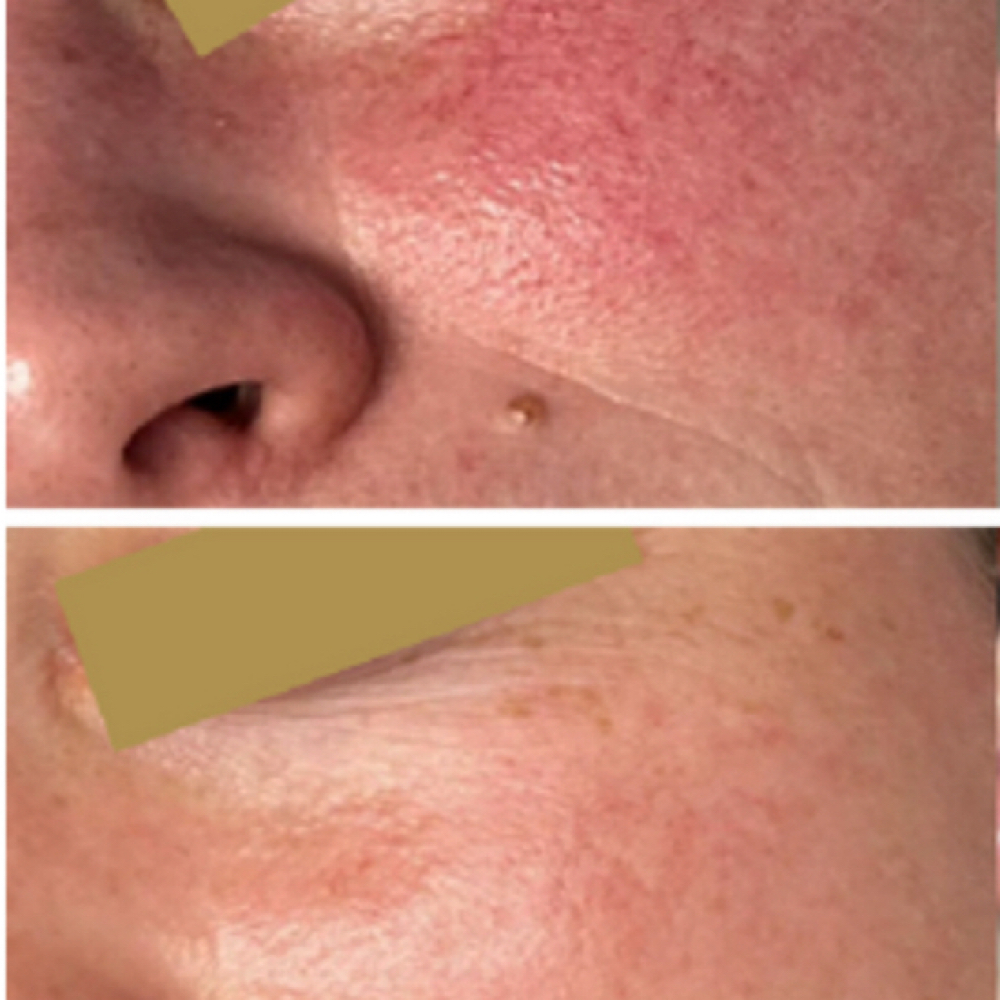 Colostrom Barrier Repair Peel