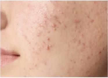 Acne Facial