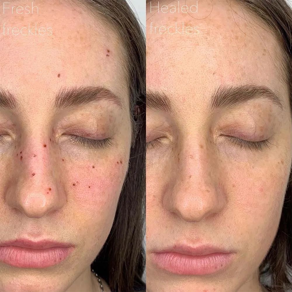 Mini Freckle