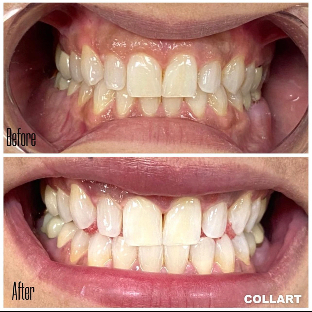 60 Min Teeth Whitening