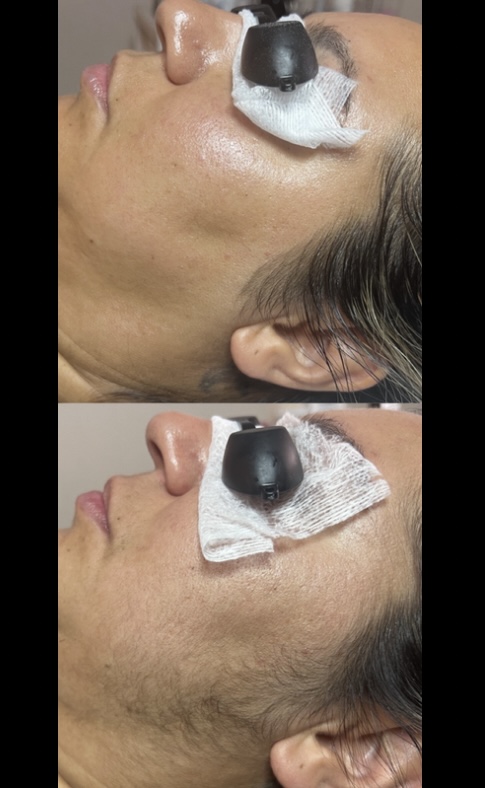 Dermaplaning facial at Ablaze Aesthetics in fitchburg, MA