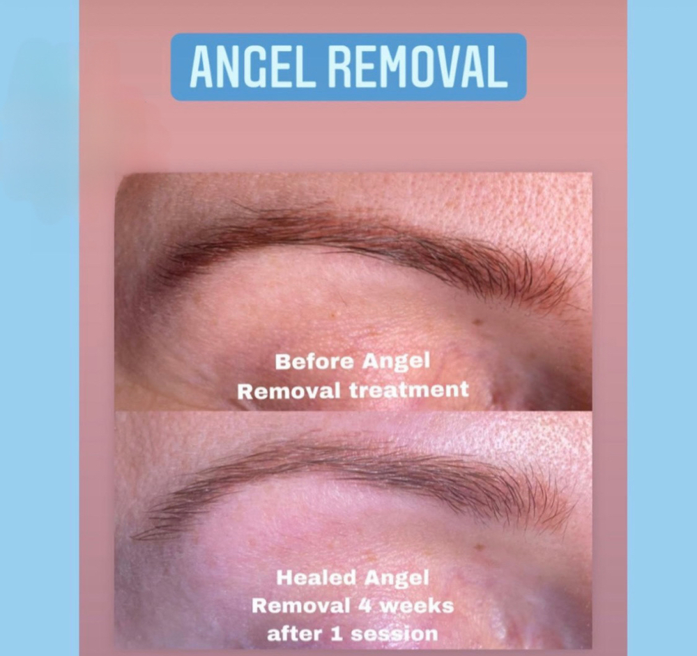 Eyebrows Tatoo Removal