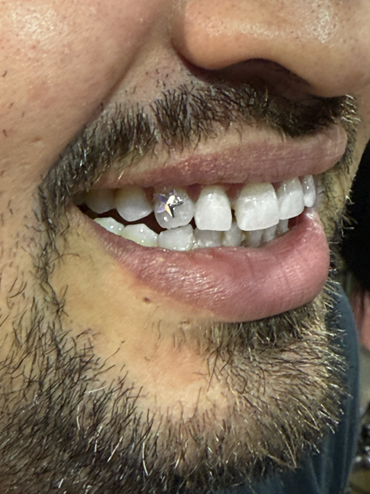 Tooth Gems