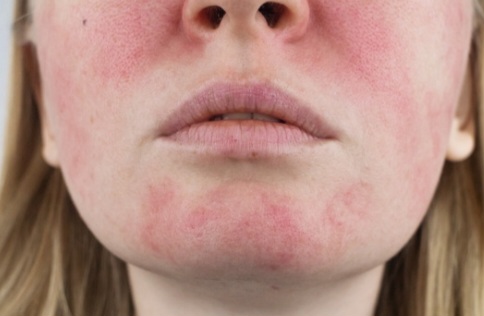 Rosacea Facial