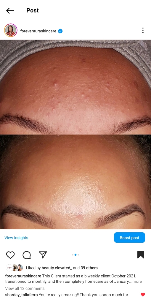 Acne Reset
