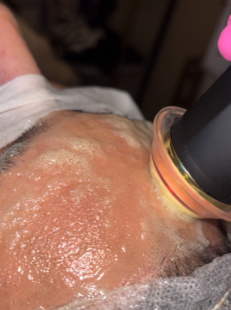 $95 Oxygen Exfoliation