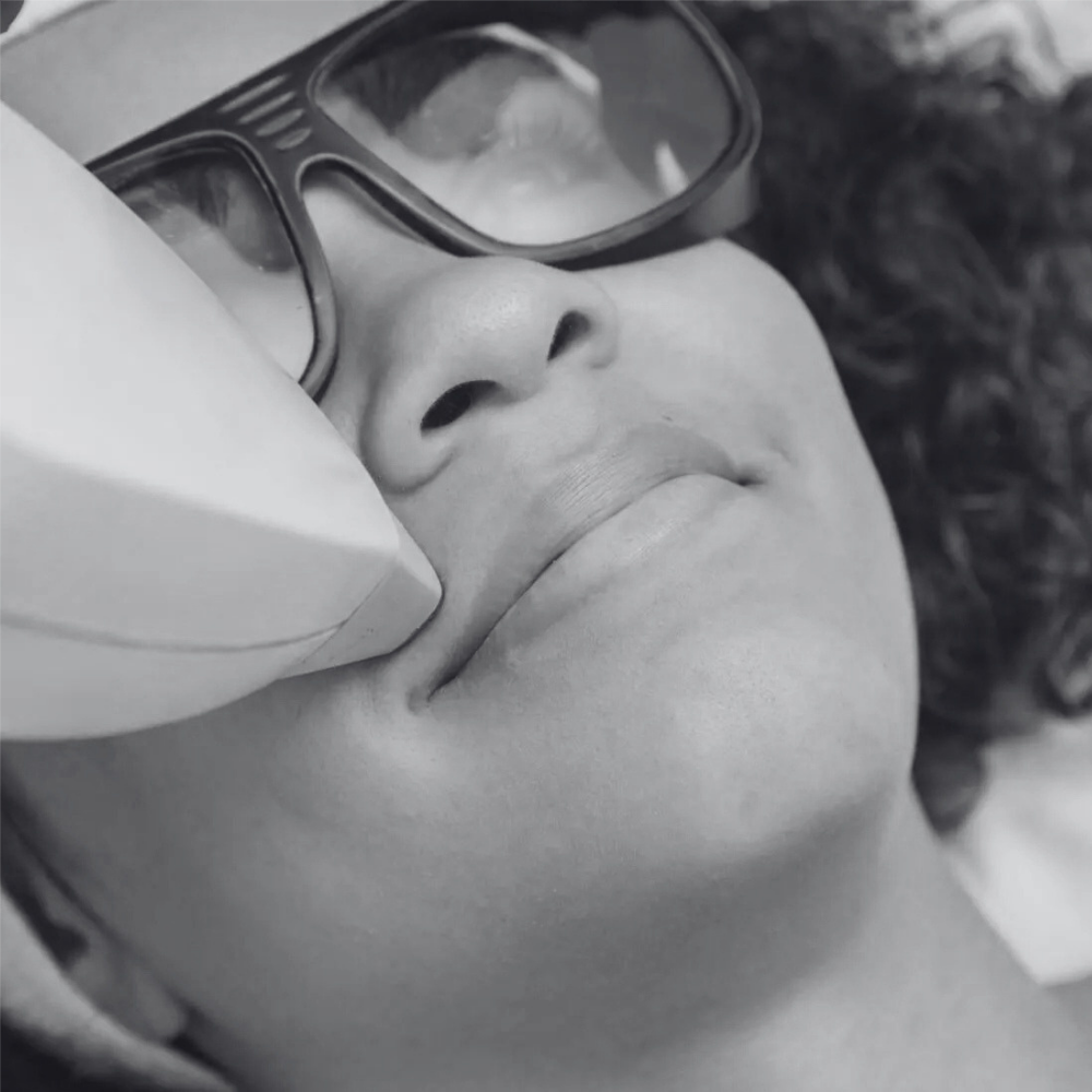 Laser Hair Removal – Upper lip at Kietre Wellness & Aesthetics in North Las Vegas, NV