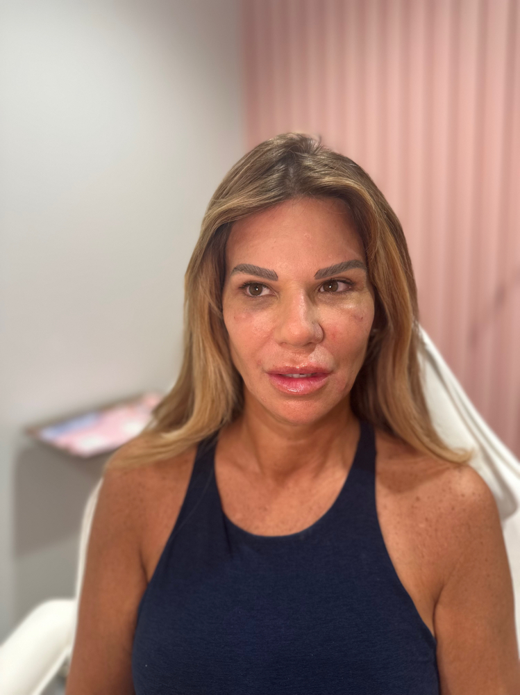 Xeomin Injections $9/unit