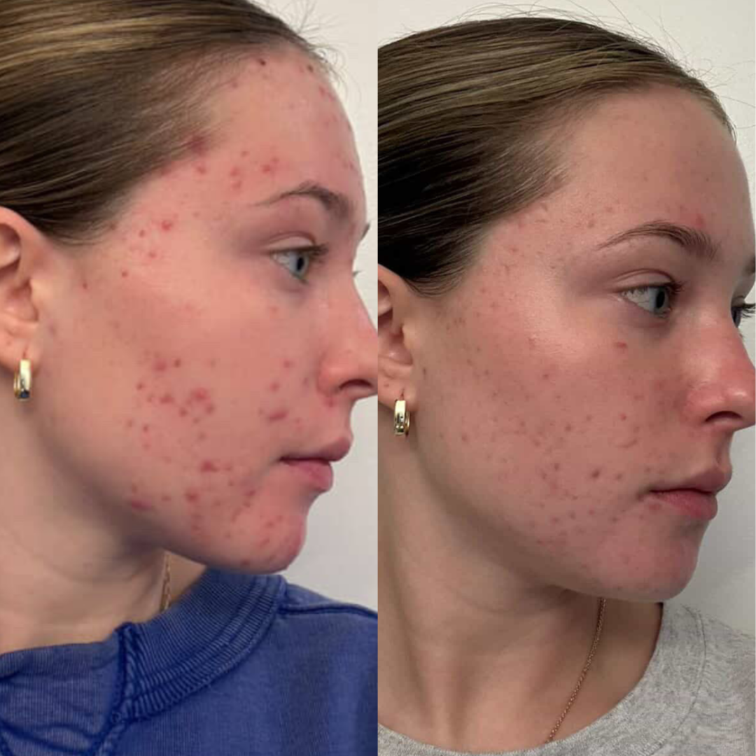 Acne Bootcamp Consultation at Cove Skin Studio in Manhattan, KS