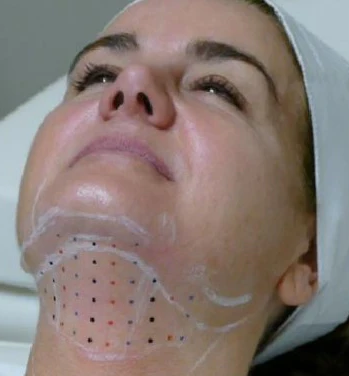 Fat Dissolve Pen | Double Chin